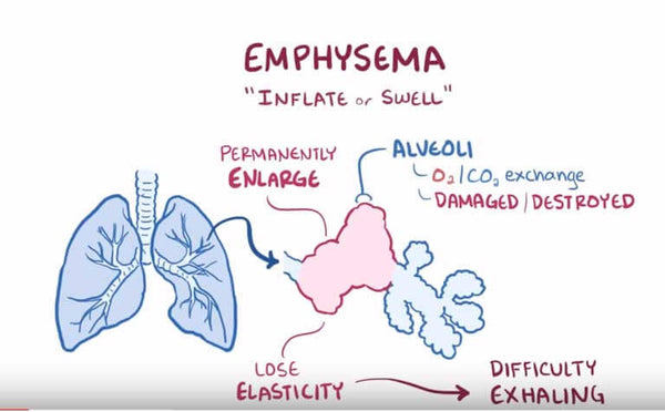 COPD Slides by Harleen Johal and Anna Longshaw Presented by Anna Longshow  Notes available online. - ppt download