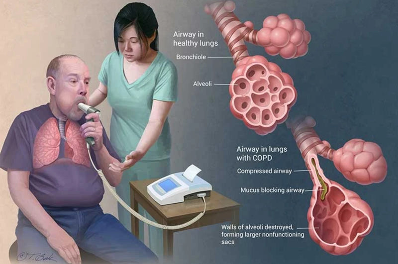 Early Diagnosis of COPD and what to do after...